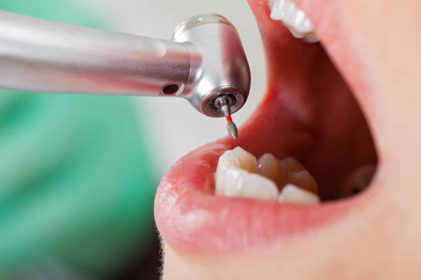 Best Emergency Root Canal Treatment in Universal City, TX